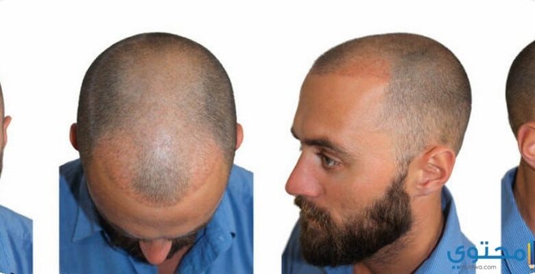 عناوين مراكز زراعة الشعر في الرياض