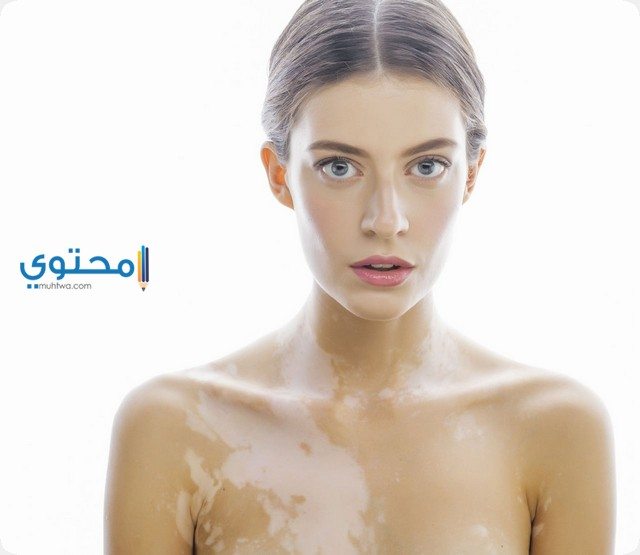 الإصابة بالبهاق والبرص في المنام