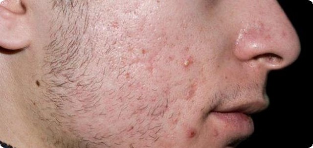 أسباب ظهور حب الشباب