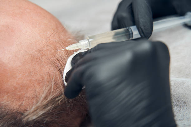 أسعار زراعة الشعر في السعودية 1446 وأشهر المراكز للزراعة