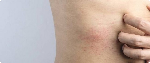 كريم ديرمافلوتيزون (Dermaflutisone) دواعي الاستخدام والاثار الجانبية