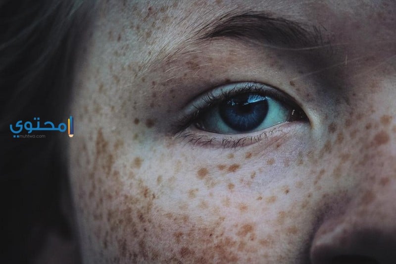 النمش والكلف والبقع الداكنة