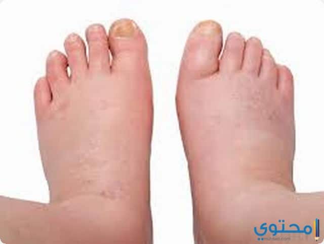 الورم في المنام