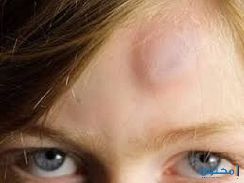 ورم في الرأس في المنام