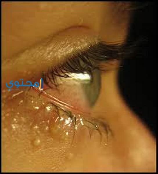 الرمد في المنام