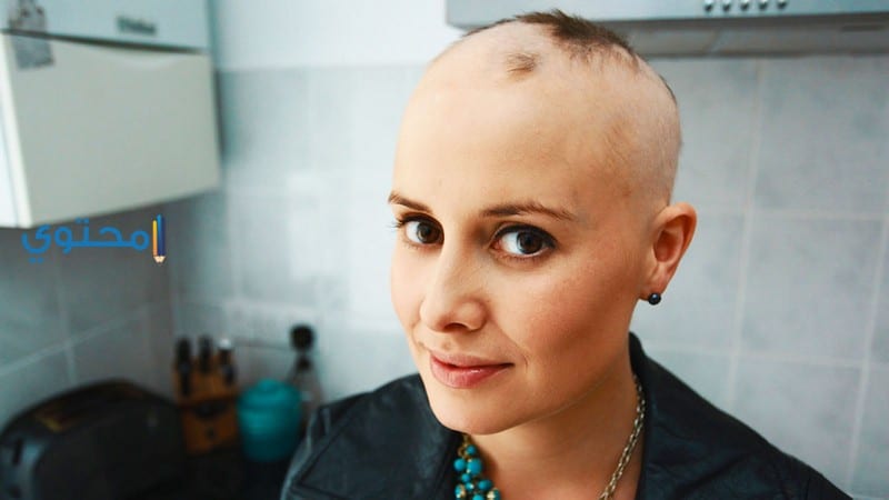 المرأة الصلعاء في المنام