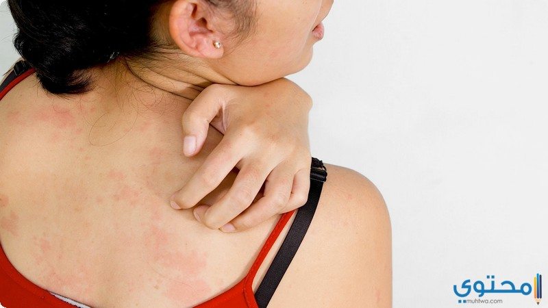 أسباب الإصابة بقمل الجسم