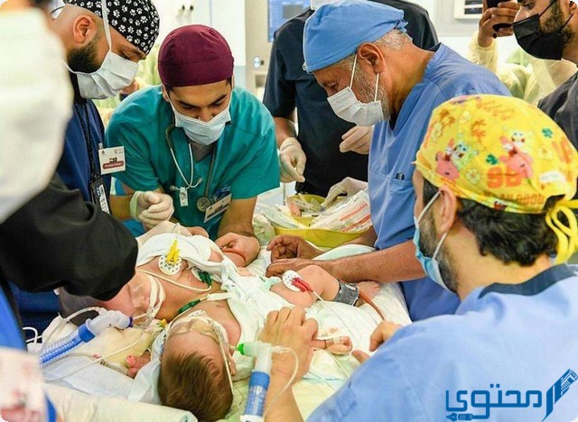 اشتهرت السعودية بعمليات فصل التوائم