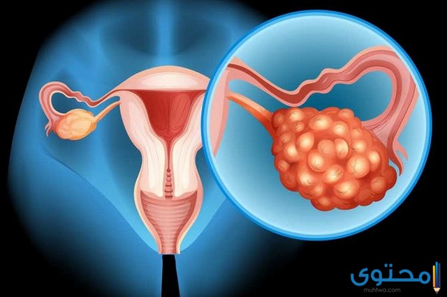 سرطان المبيض