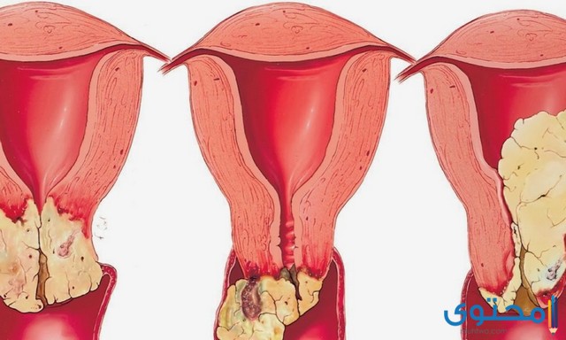 كريم لالتهاب المهبل