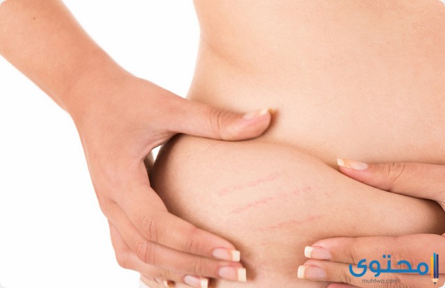 التخلص من علامات التمدد الحمراء