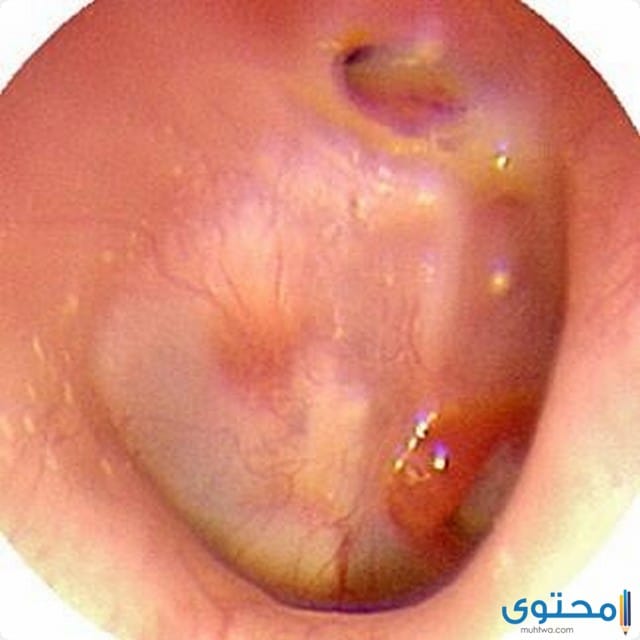 التهاب الأذن الوسطى