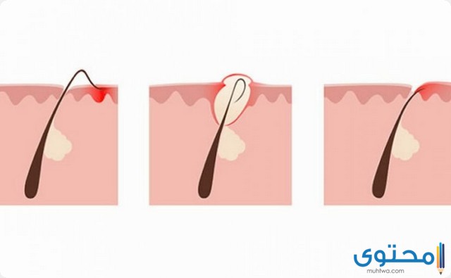 الشعر المدفون تحت الجلد