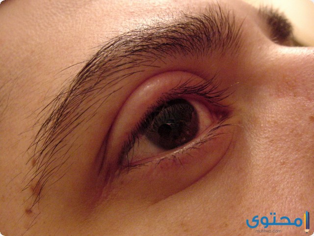 العين المنتفخة في المنام