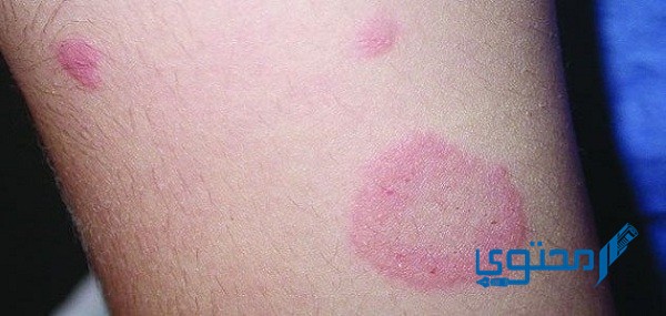 تجربتي مع النخالة الوردية