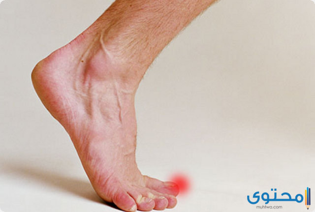 تجربتي مع علاج الغرغرينا