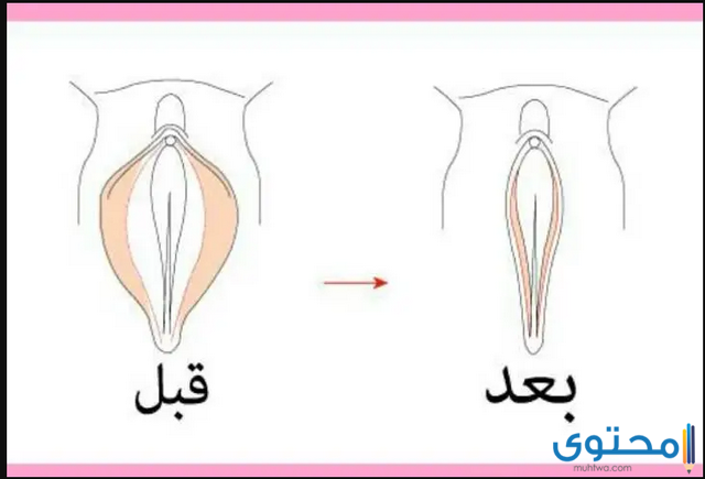 تجربتي مع عملية تضييق المهبل بالليزر