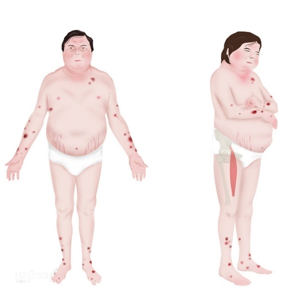 تجربتي مع متلازمة كوشينغ