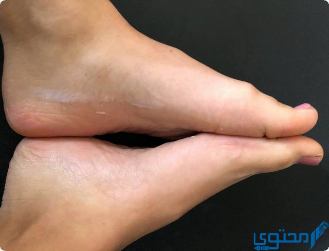 تشقق كعب القدم في المنام