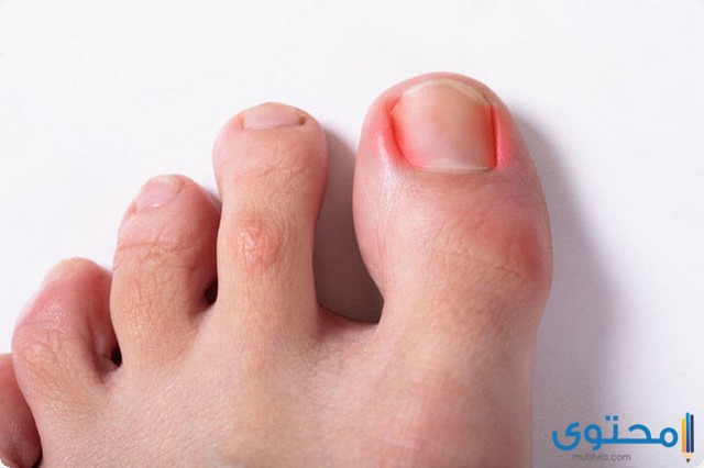 تورم اصبع القدم الكبير