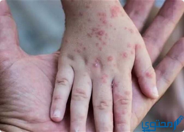 جدري القرود في مصر