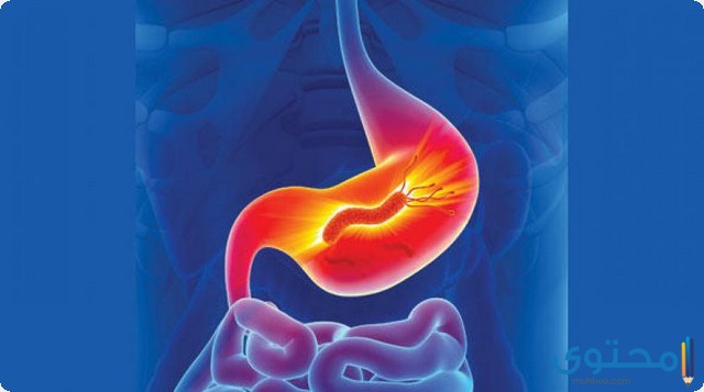 جرثومة المعدة مع البراز
