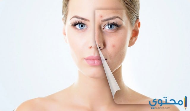 علاج حب الشباب Acne و اسبابه