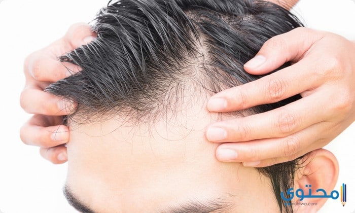 أسعار زراعة الشعر بالليزر في مصر