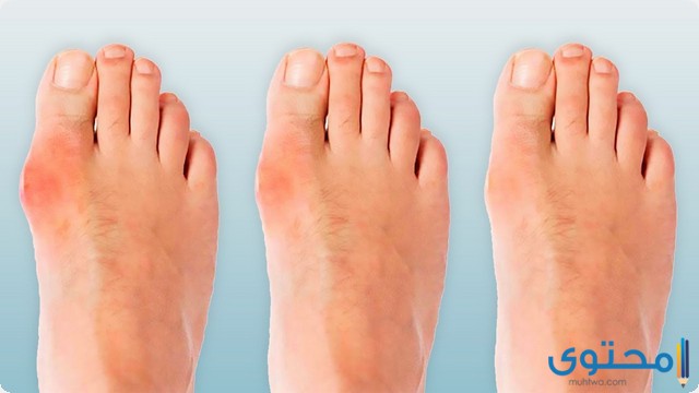 سبب تورم الأصبع الكبير