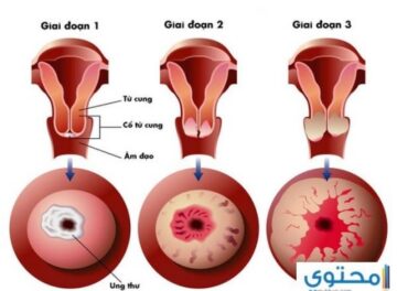 أعراض سرطان الرحم