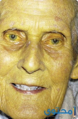 شخص وجهه أصفر في المنام