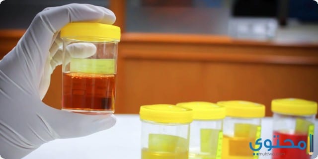 علاج صديد البول