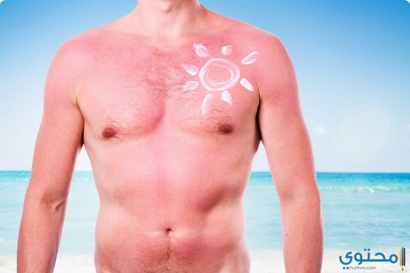 علاج ضربة الشمس