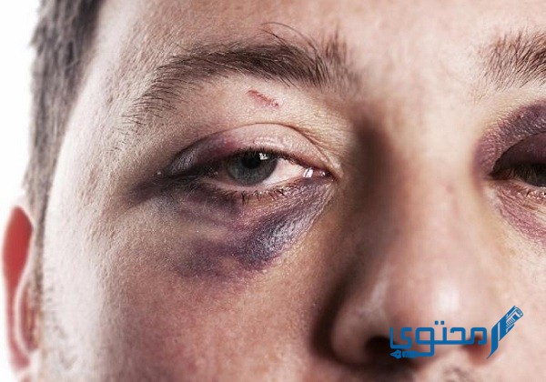 طريقة التخلص من كدمات الوجه