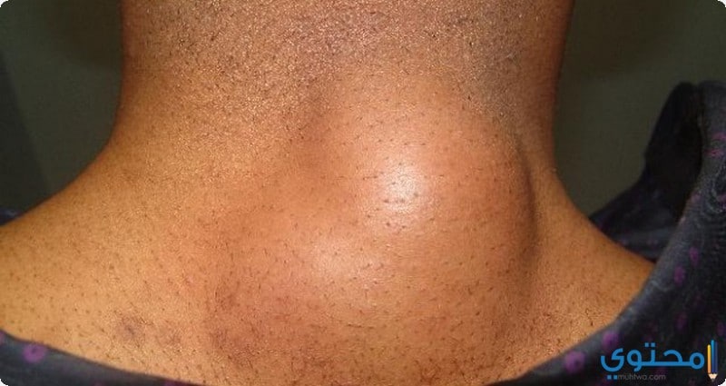 أسباب ظهور الأكياس الدهنية