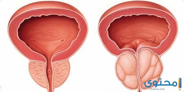 علاج البروستاتا بالأدوية والاعشاب والطب البديل