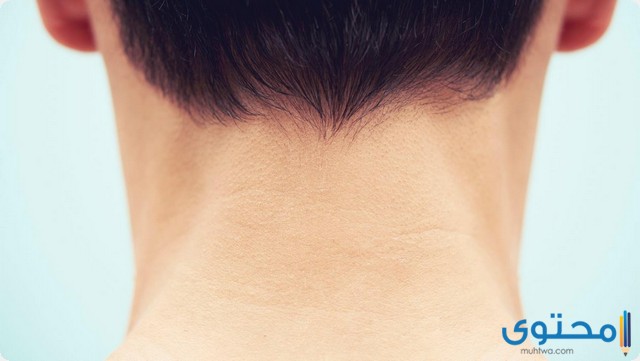 علاج التينيا الملونة