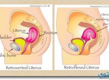 الرحم المقلوب3