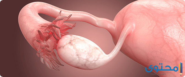 علاج انسداد قناة فالوب