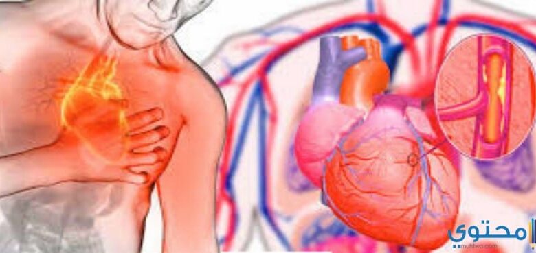 علاج مرض تصلب الشرايين بأحدث الطرق