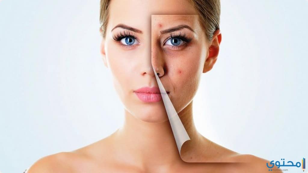 علاج حب الشباب