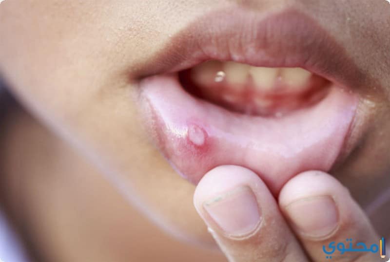 علاج فطريات الفم بالأعشاب