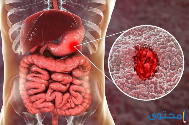 مريض السرطان الكبد