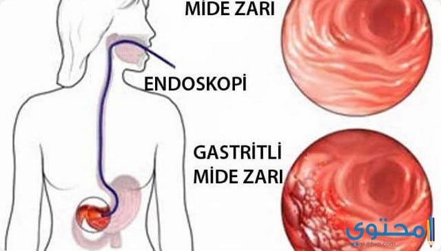 ما هي قرحة المعدة وما هي احدث طرق علاجها