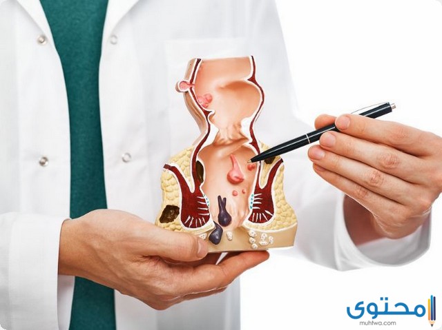 كيف تختفي البواسير الخارجية