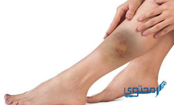 ما سبب ظهور اللون الأصفر في أثناء شفاء الكدم