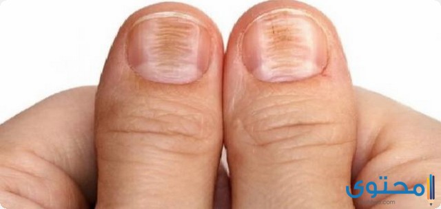 مرض البري بري