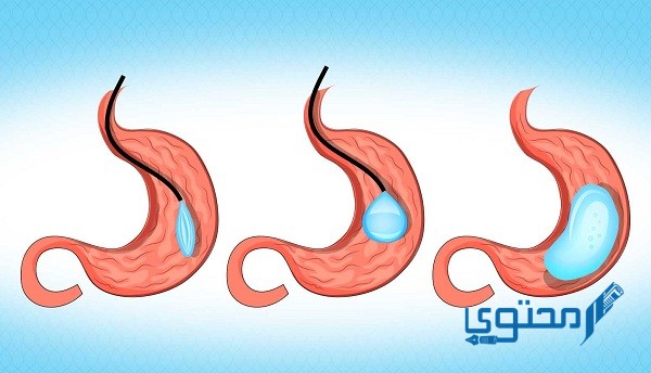 مين جربت بالون المعدة ونحفت