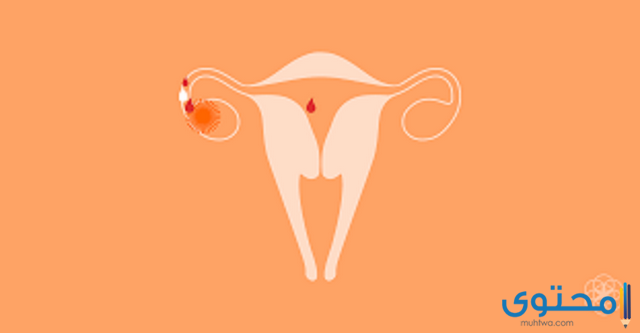 نزول خيوط دم